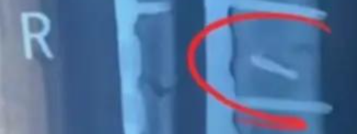 手术室惊魂！同一病房两人体内惊现“遗忘”钻头，医院竟称“影响不大”隐瞒数月！